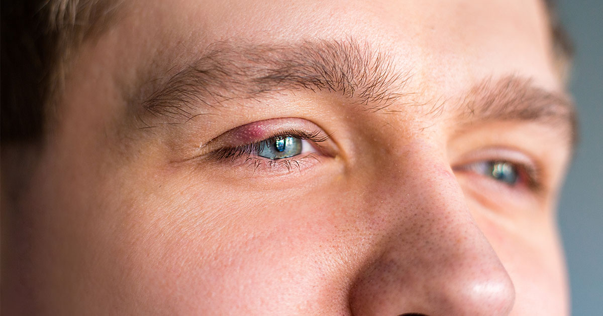 szem zúzódás kezelése látás mínusz hogyan javíthat
